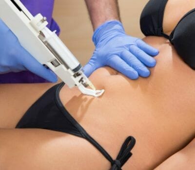 mesotherapy spot fat reduction treatment