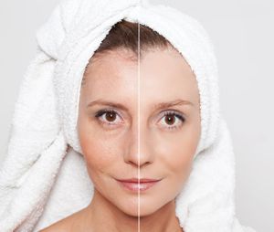 before and after skin rejuvenation