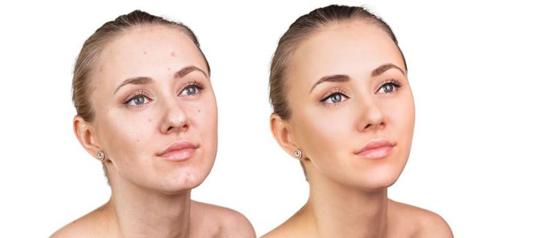a before and after of a young woman with a chemical peel
