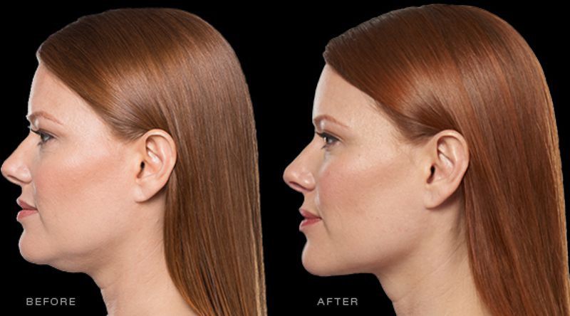 chin fat reduction with Kybella