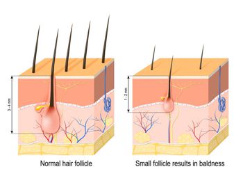 Hair loss (baldness). Normal hair follicle and skin with Alopecia. human skin.