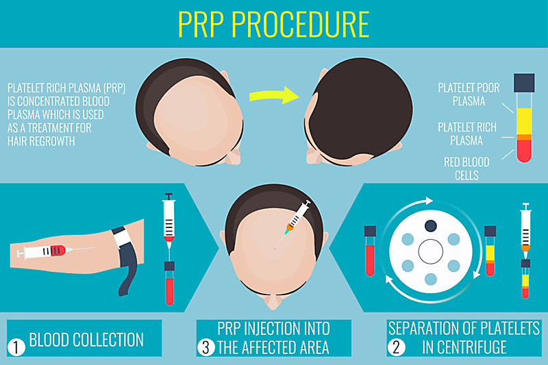prp procedure for male pattern baldness