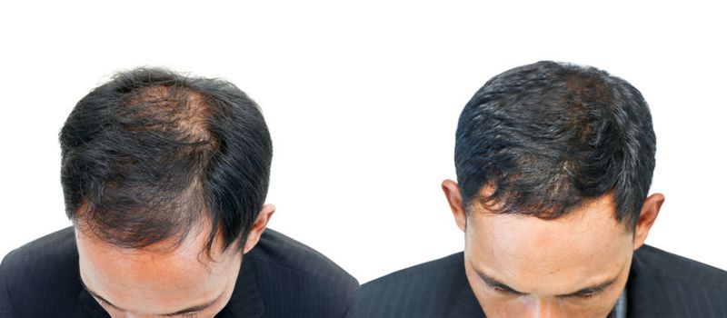 before and after alopecia treatment with prp hair restoration
