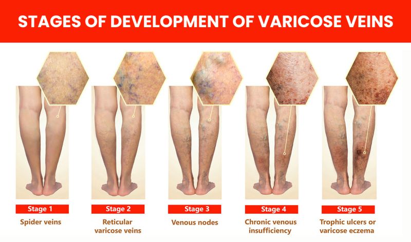 stages of varicose veins