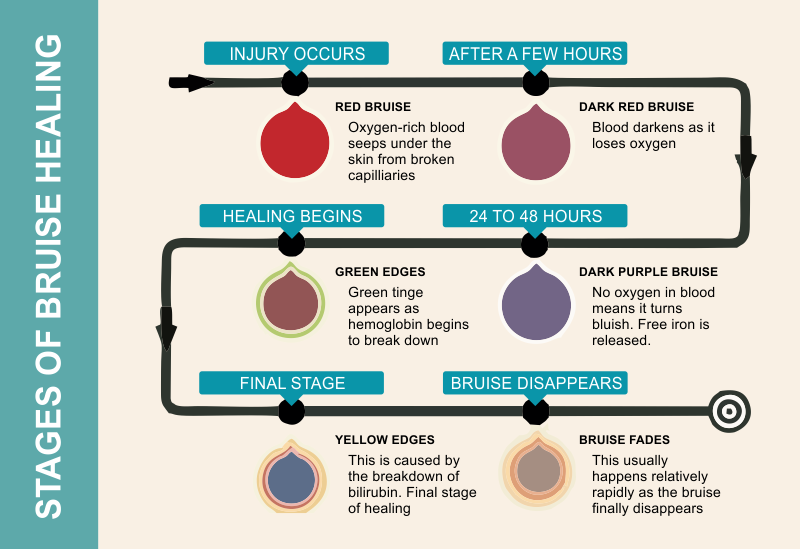 the stages of bruise healing
