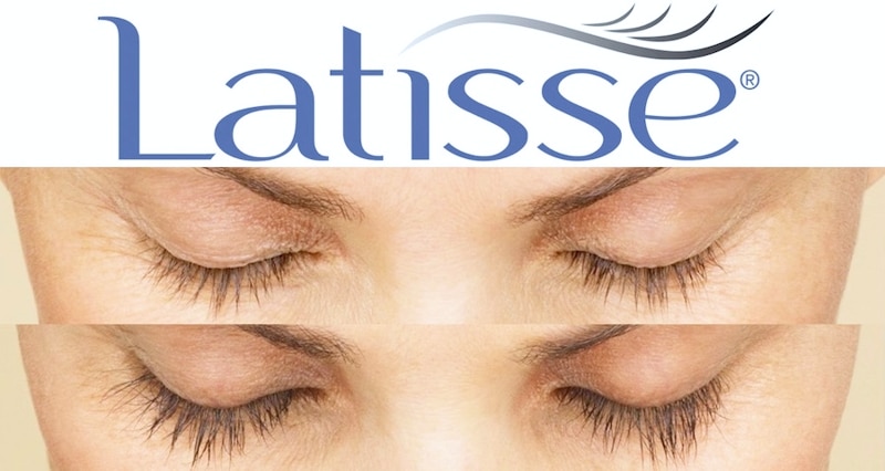 before and after latisse treatment on a typical patient