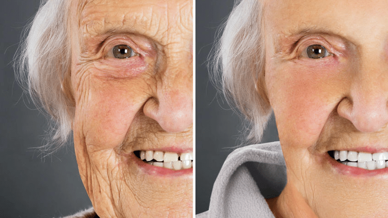 elderly woman before and after Juvederm
