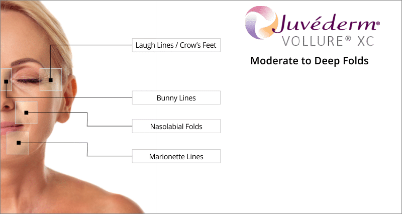 treatment areas juvederm vollure