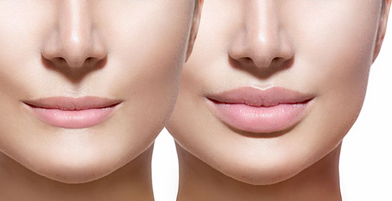 before and after lip filler with restylane