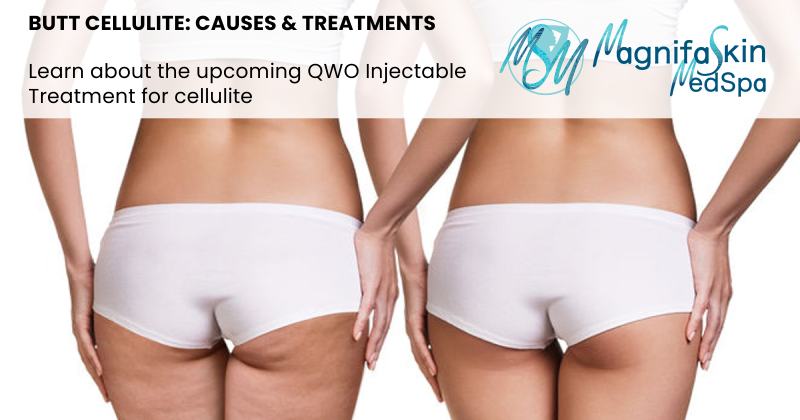 butt cellulite causes and treatments featured image