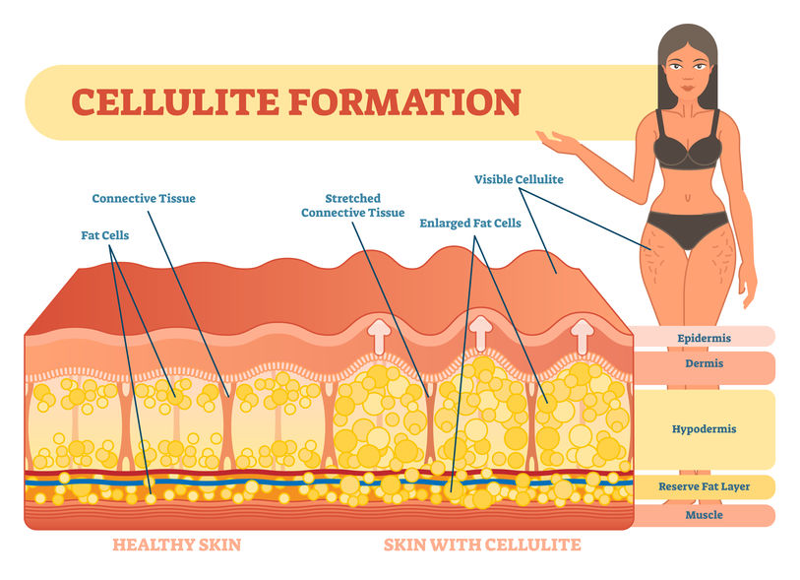 Cellulite most often forms when weakened connective tissues are pushed up in an irregular pattern by underlying fat