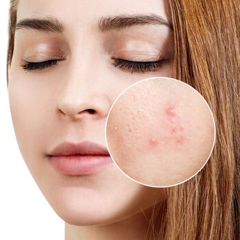 7 feel-good beauty treatments for Acne