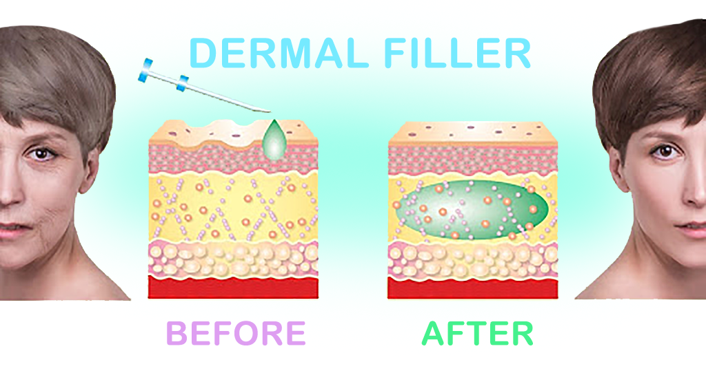 Dermal Filler Before and After