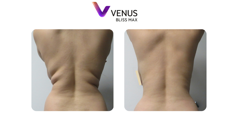 VenusBlissMax VenusBlissMax